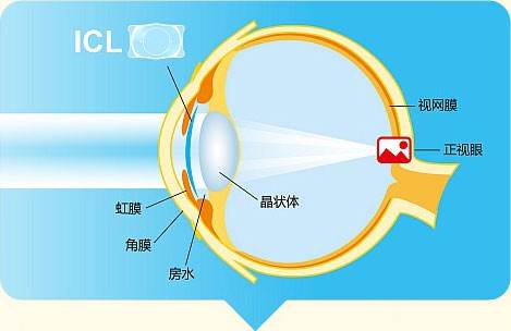 深圳icl人工晶体为什么可以长期置于眼中