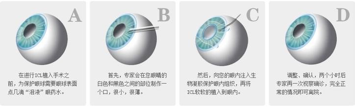 Icl晶体植入有没有副作用 德视佳