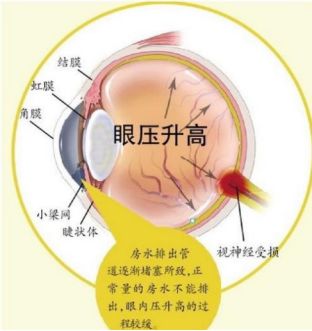 中國特色的五種致盲性眼病