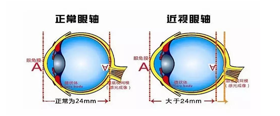 一,近视眼修复的原理目前近视眼修复所采取的方式主要是进行手术,不同